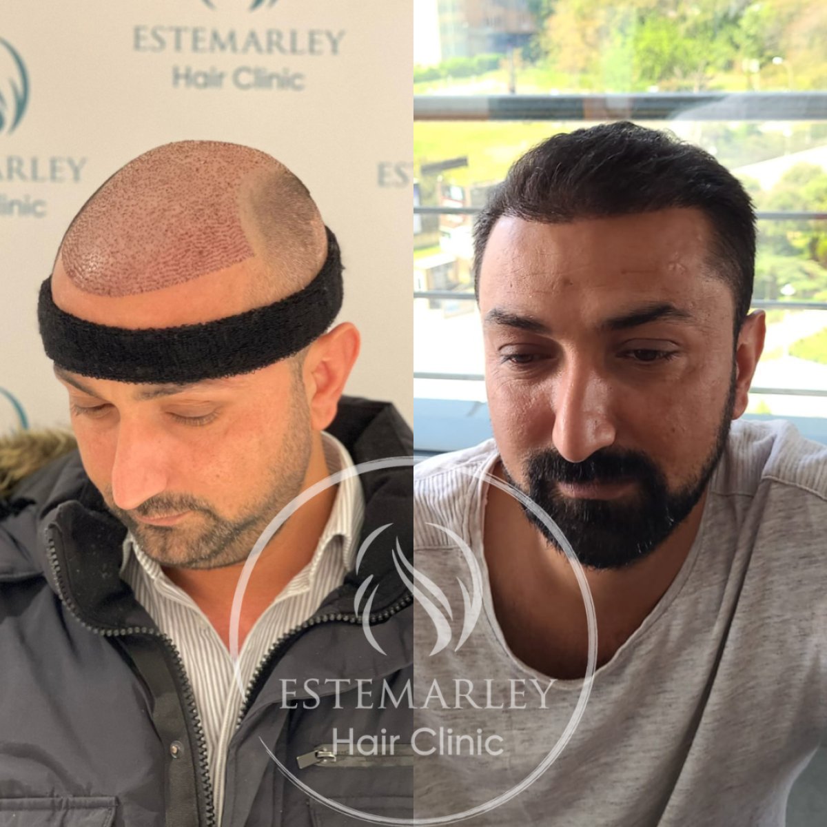 Resultados de trasplante capilar antes y después en Estemarley – línea capilar restaurada