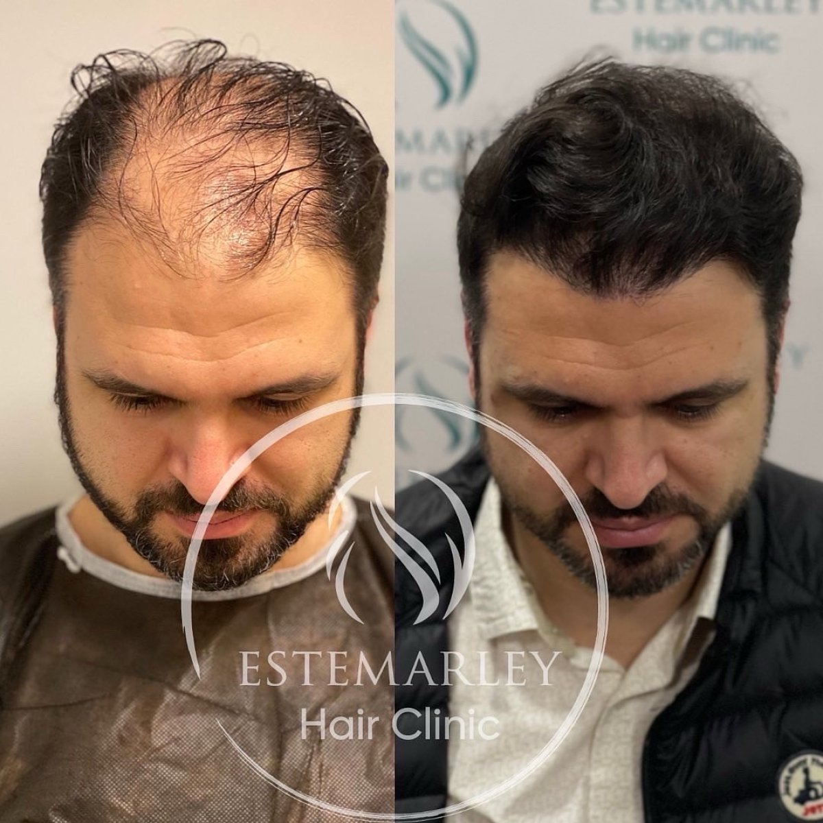 Before and after hair transplant results at Estemarley – restored hairline and fuller hair