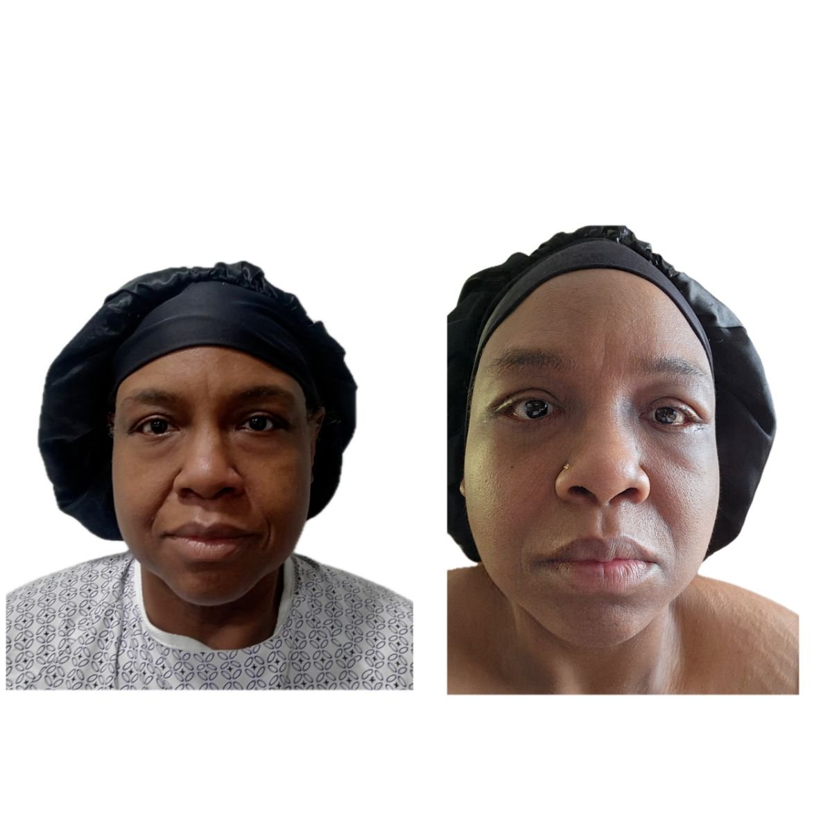 Résultats avant et après deep plane facelift à l'Hospital de la Familia, rajeunissement du visage