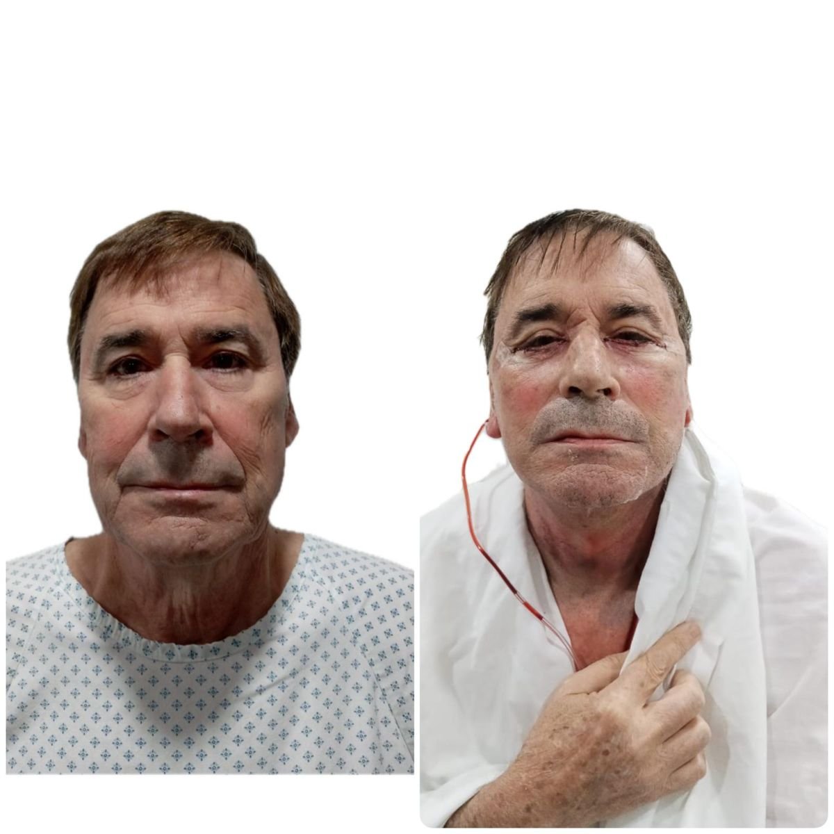 Résultats avant/après lifting deep plane à l'Hospital de la Familia, rajeunissement du visage