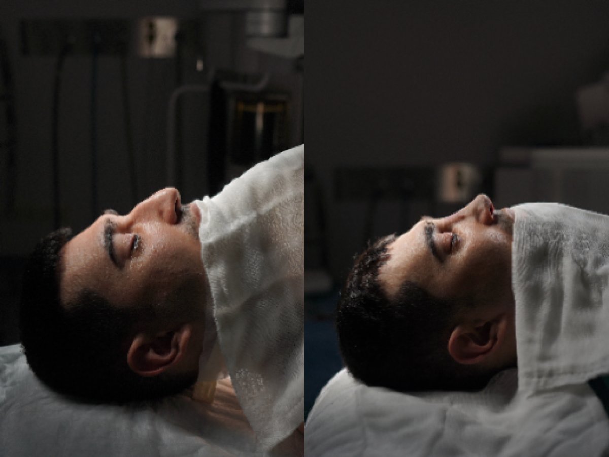 Resultados de rinoplastia antes y después en Op. Dr. Sinan Eroglu Clinic, perfil nasal mejorado