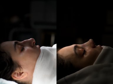 Rhinoplasty + Brow Lift Package All Included - photo 6