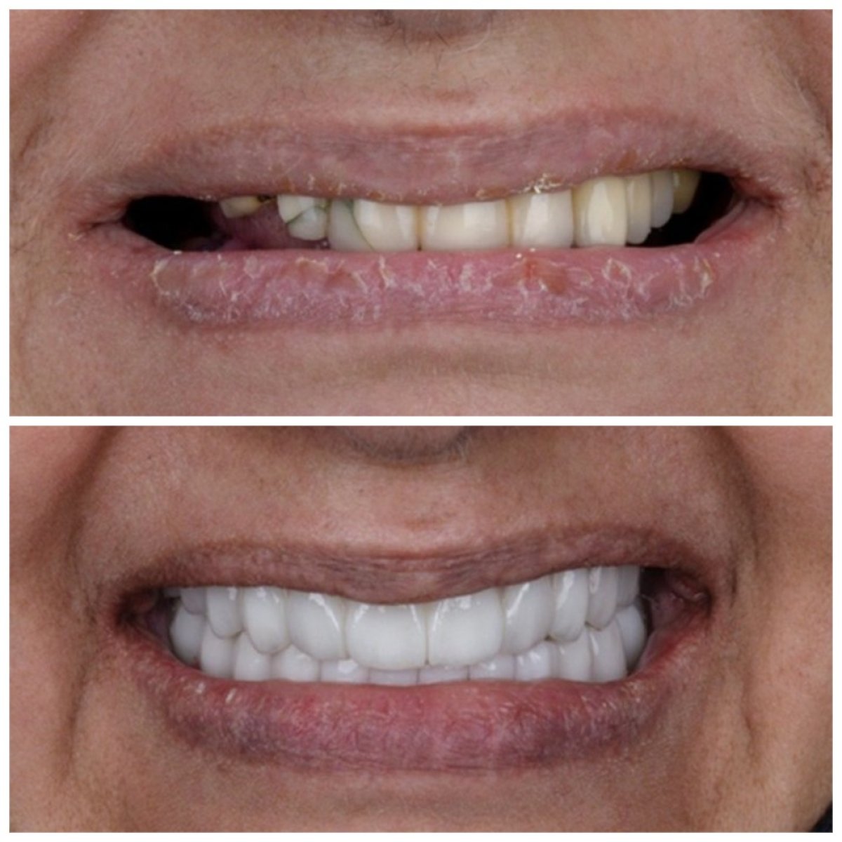 Résultat avant et après implants All-on-6 chez Omara Dental Centers, sourire amélioré