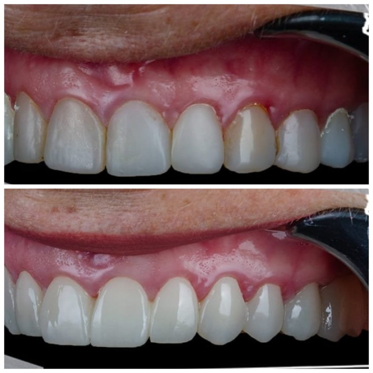 نتائج قبل وبعد تركيب تيجان الزركونيا في Omara Dental Centers وتحسن الابتسامة