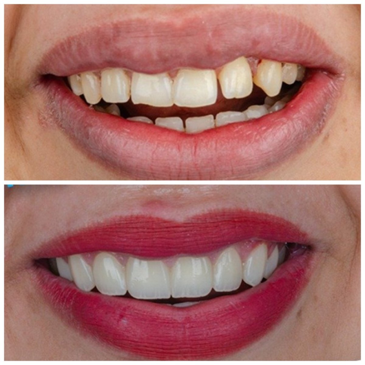 Результаты до и после установки циркониевых коронок в Omara Dental Centers, улыбка