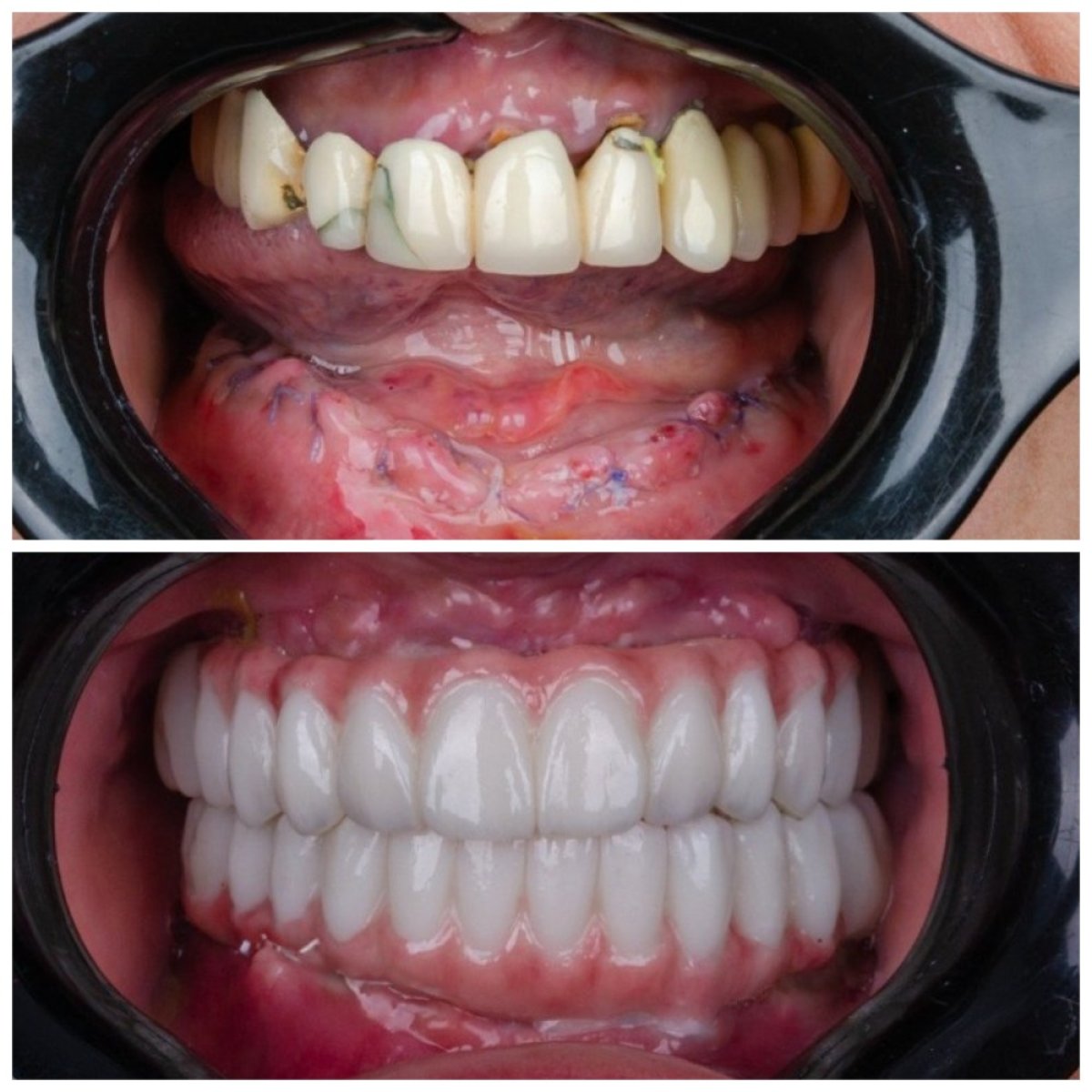 Resultados antes y después de implantes All-on-4 en Omara Dental Centers, restauración total de sonrisa