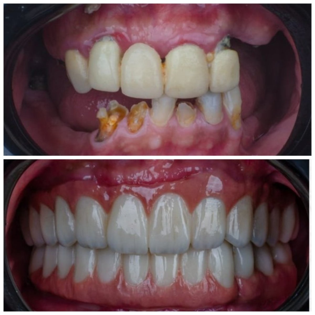 Before and after All-on-4 dental implants result at Omara Dental Centers, full smile restoration