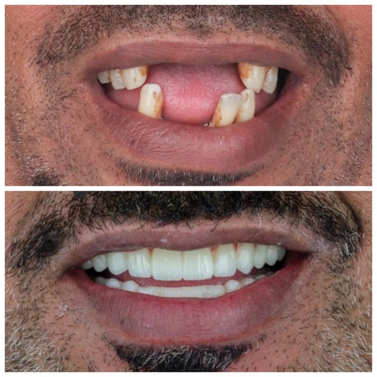 Результат до та після імплантації All-on-4 в Omara Dental Centers, відновлена посмішка