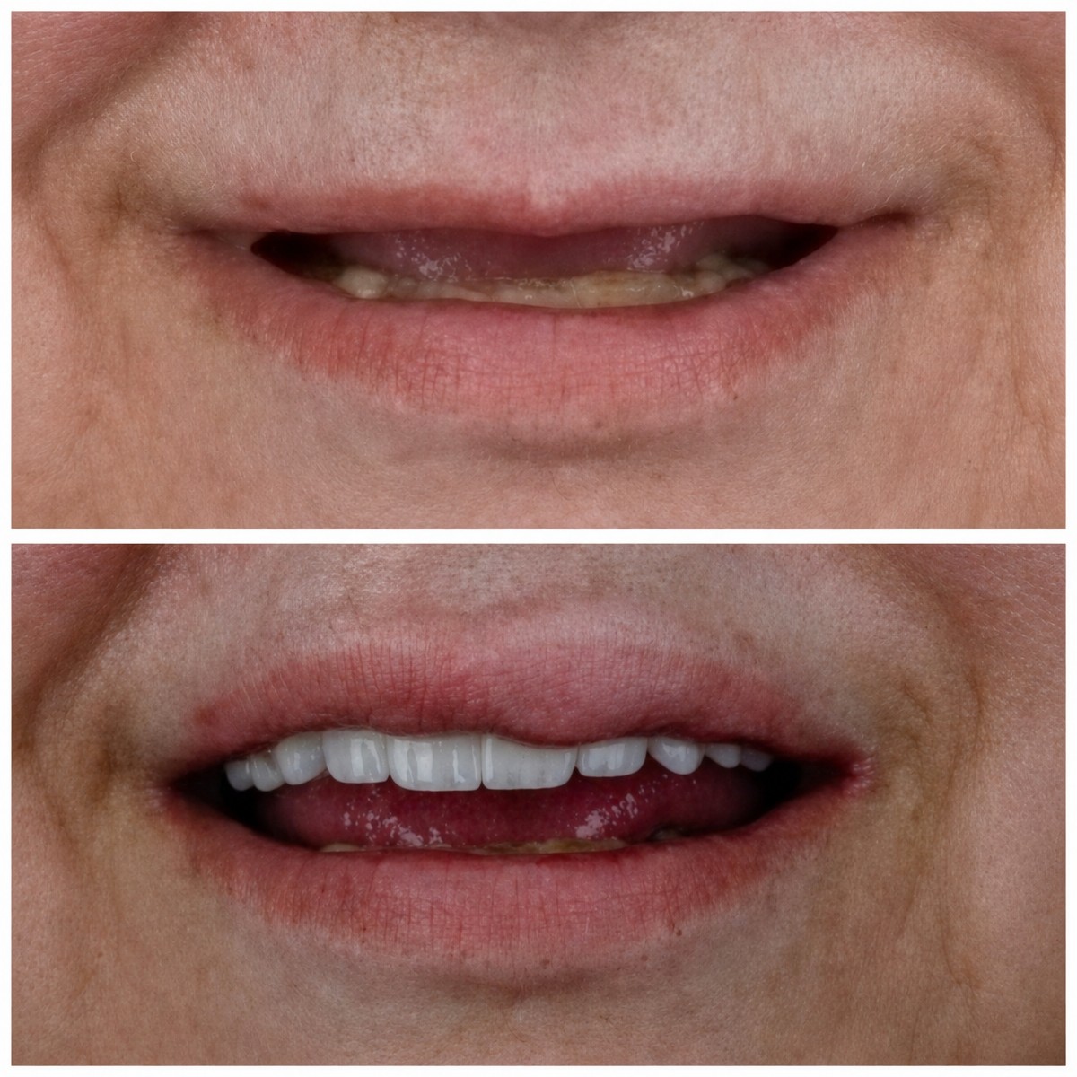 نتيجة قبل وبعد زراعة الأسنان All-on-4 في Omara Dental Centers، ابتسامة مستعادة
