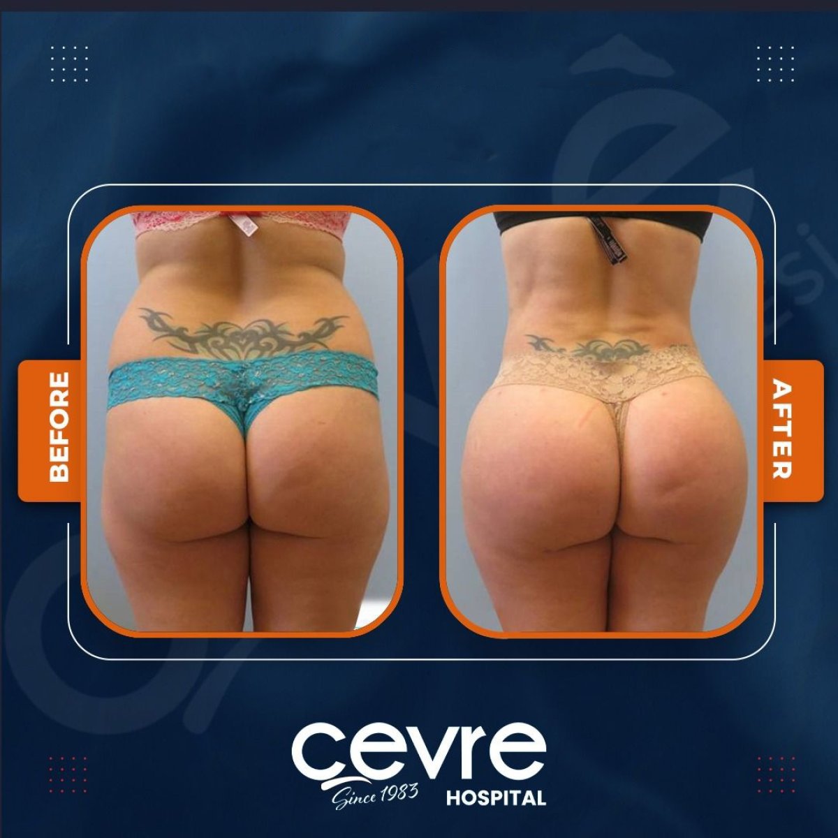Resultados de lifting de glúteos antes y después en Adem and Havva Medical Center, contorno mejorado