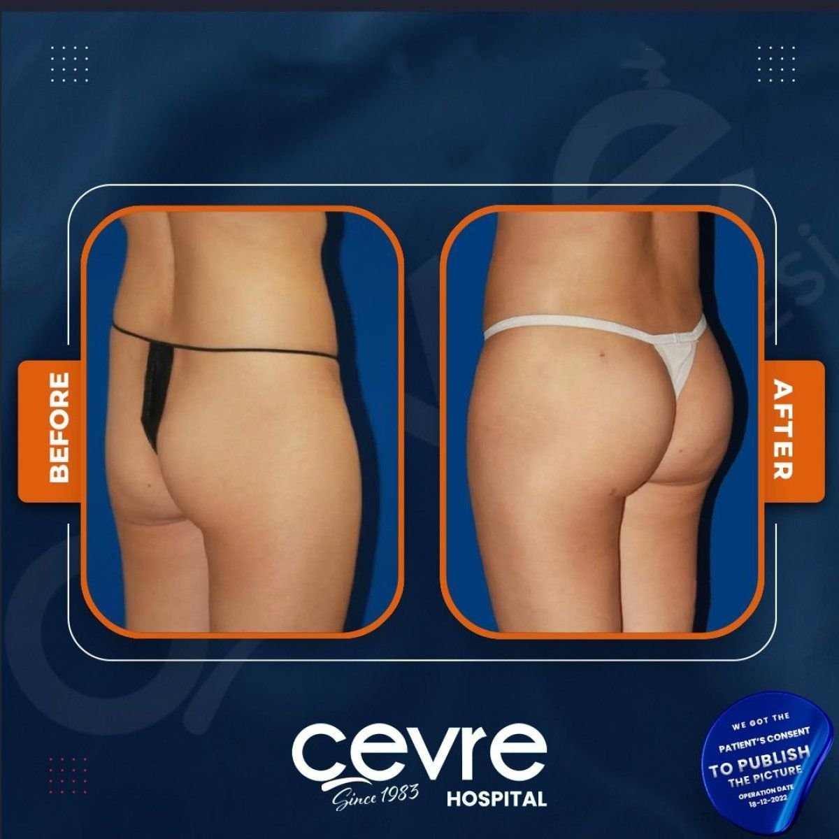 Before and after buttock lift results at Adem and Havva Medical Center, enhanced contour visible
