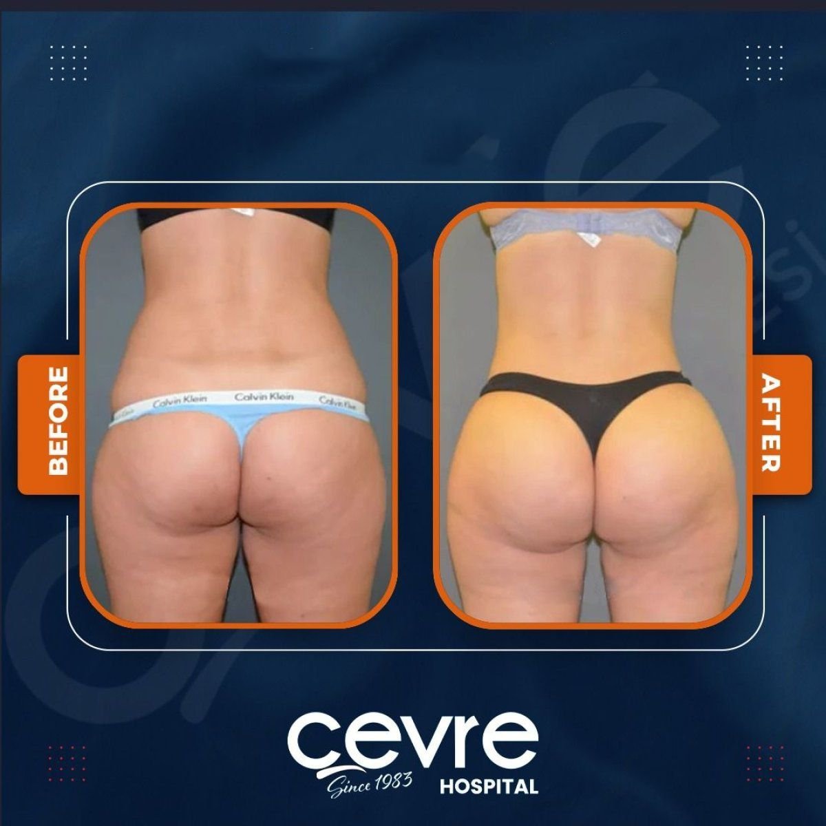 Результаты подтяжки ягодиц до и после в Adem and Havva Medical Center, улучшенный контур