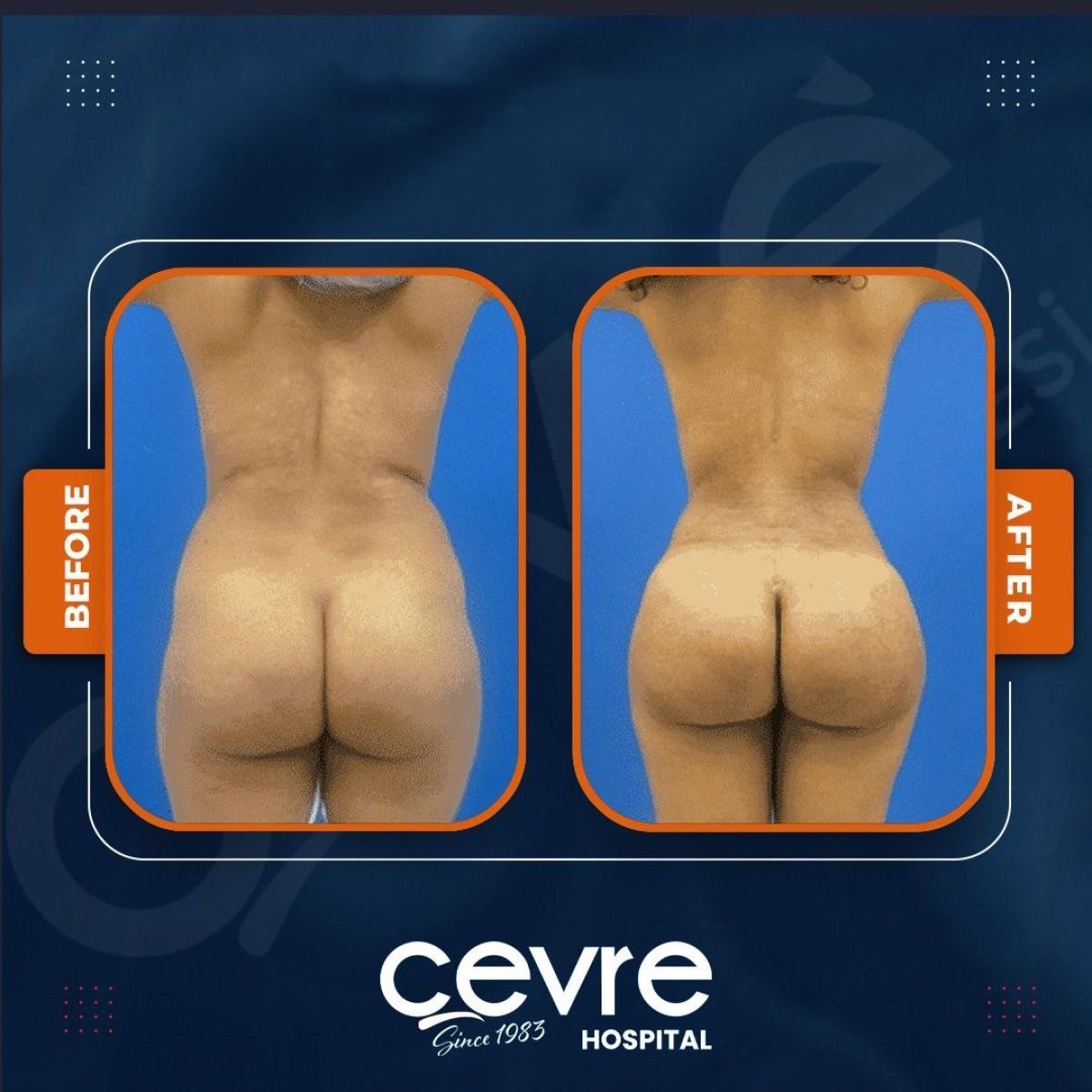 Результаты подтяжки ягодиц до и после в Adem and Havva Medical Center, улучшенный контур