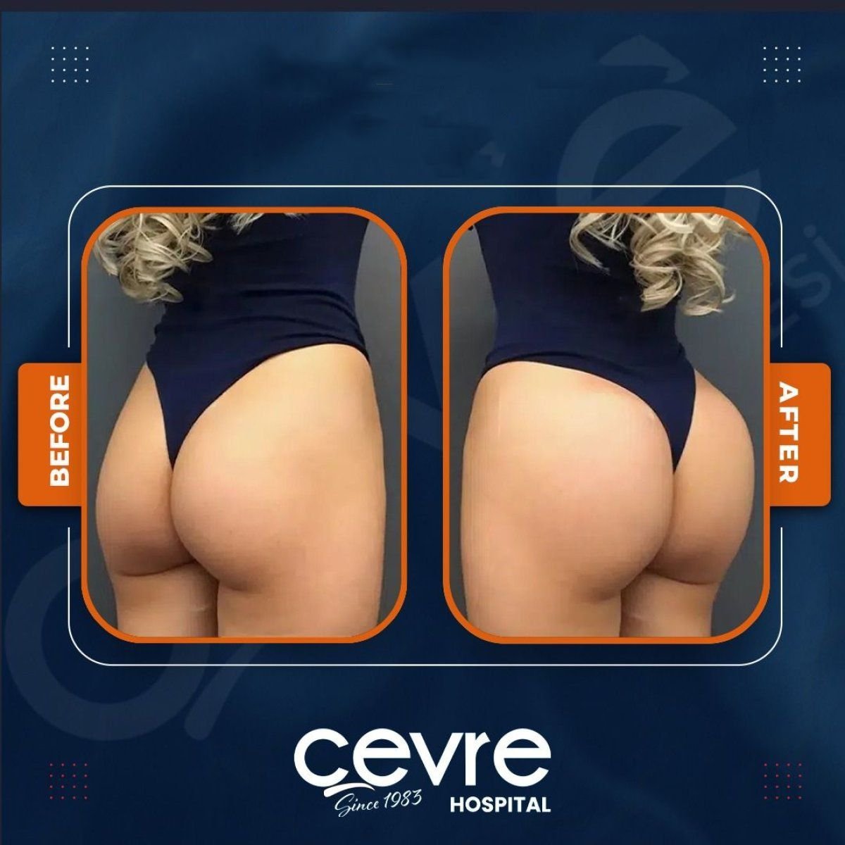 Before and after buttock lift results at Adem and Havva Medical Center, enhanced contour visible