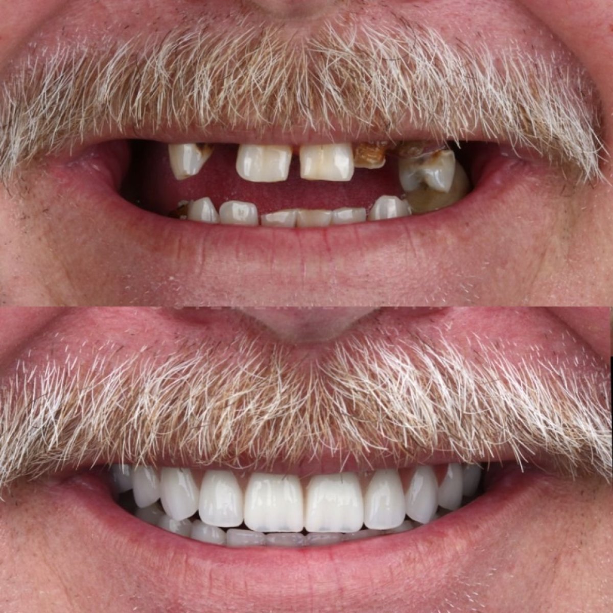 Résultat avant/après implants dentaires All-on-6 chez European Valley Health, sourire restauré
