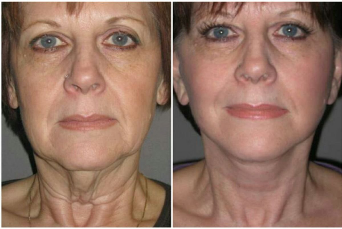 Before and after deep plane facelift results at CE International Hospital, facial rejuvenation