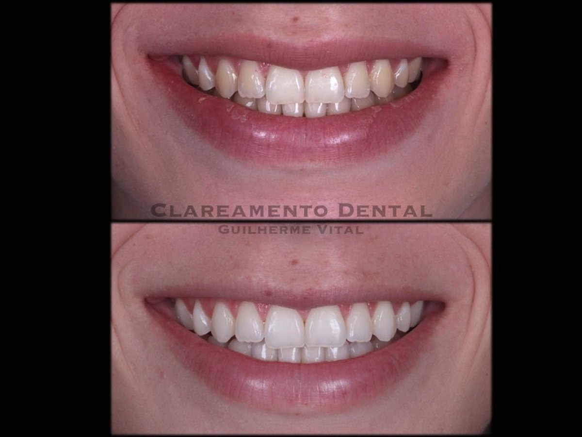 Before and after tooth whitening results at European Valley Health, brighter smile achieved