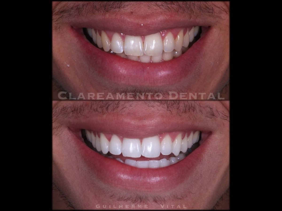 Before and after tooth whitening results at European Valley Health – brighter, whiter smile