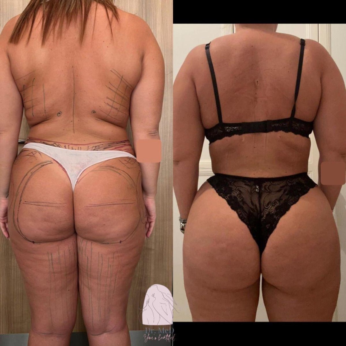 نتائج شفط الدهون قبل وبعد في Dr. MED – تحديد الجسم وتقليل الدهون بشكل واضح