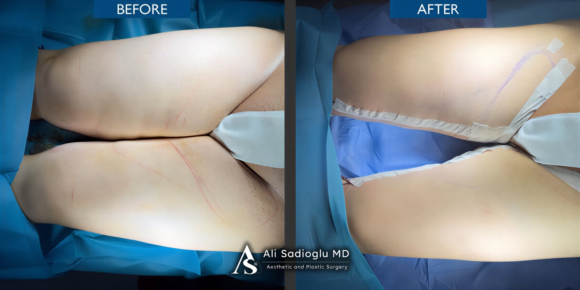 Resultados de lifting de muslos antes y después en Dr. Safa Manav Clinic, contorno mejorado