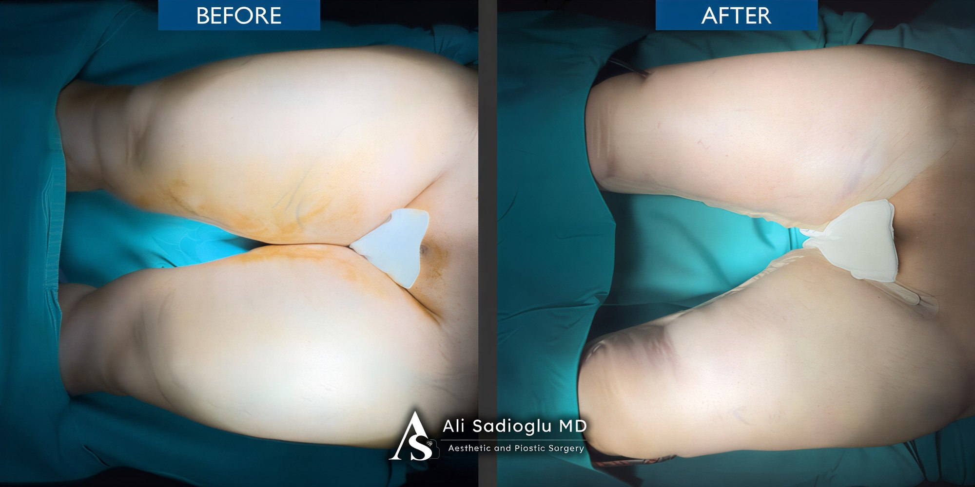 Resultados antes y después de lifting de muslos en Dr. Safa Manav Clinic, contorno mejorado
