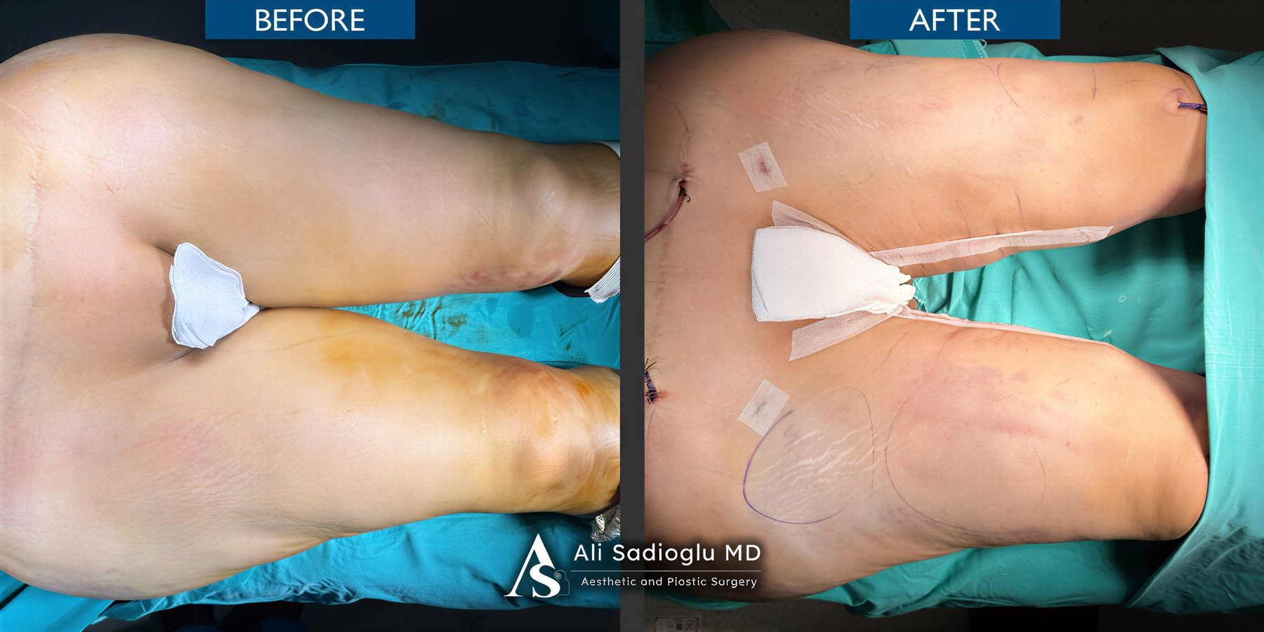 Resultados de lifting de muslos antes y después en Dr. Safa Manav Clinic, contorno mejorado