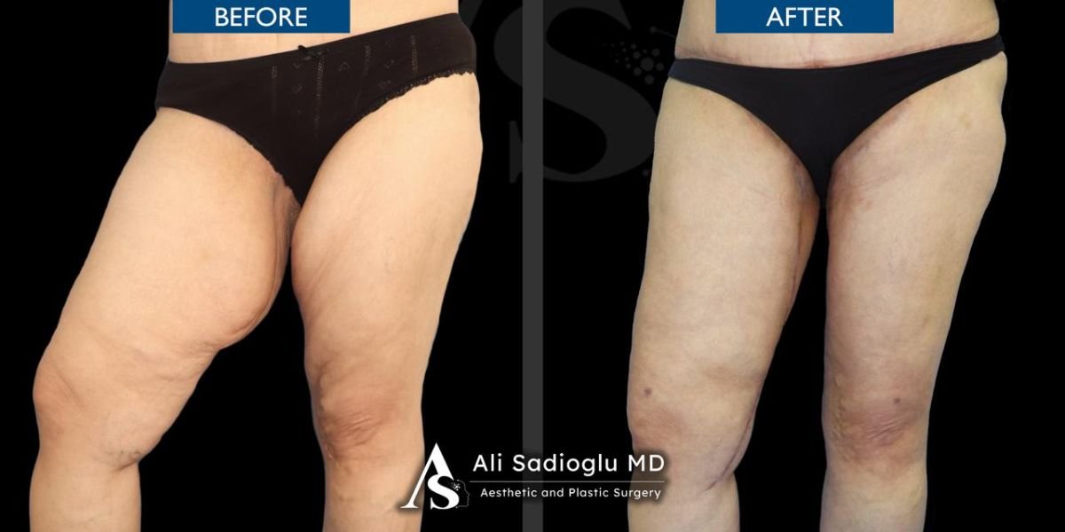 Résultats avant/après lifting des cuisses à la clinique Dr. Safa Manav – cuisses raffermies