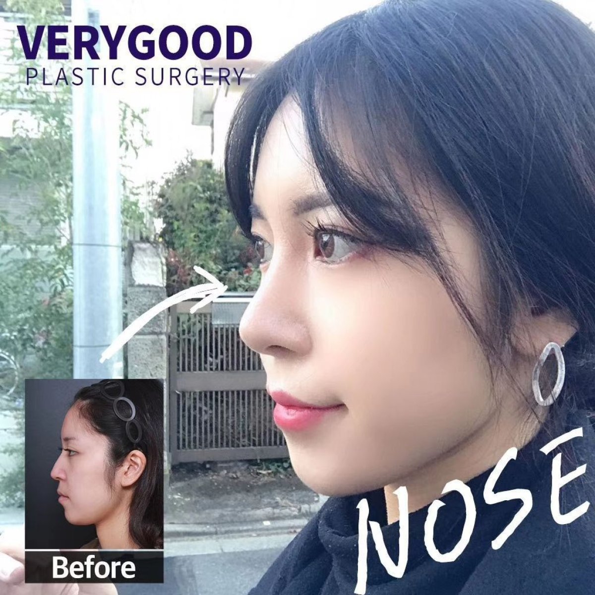 نتائج قبل وبعد عملية تجميل الأنف المفتوحة في VG Plastic Surgery، تحسين شكل الأنف