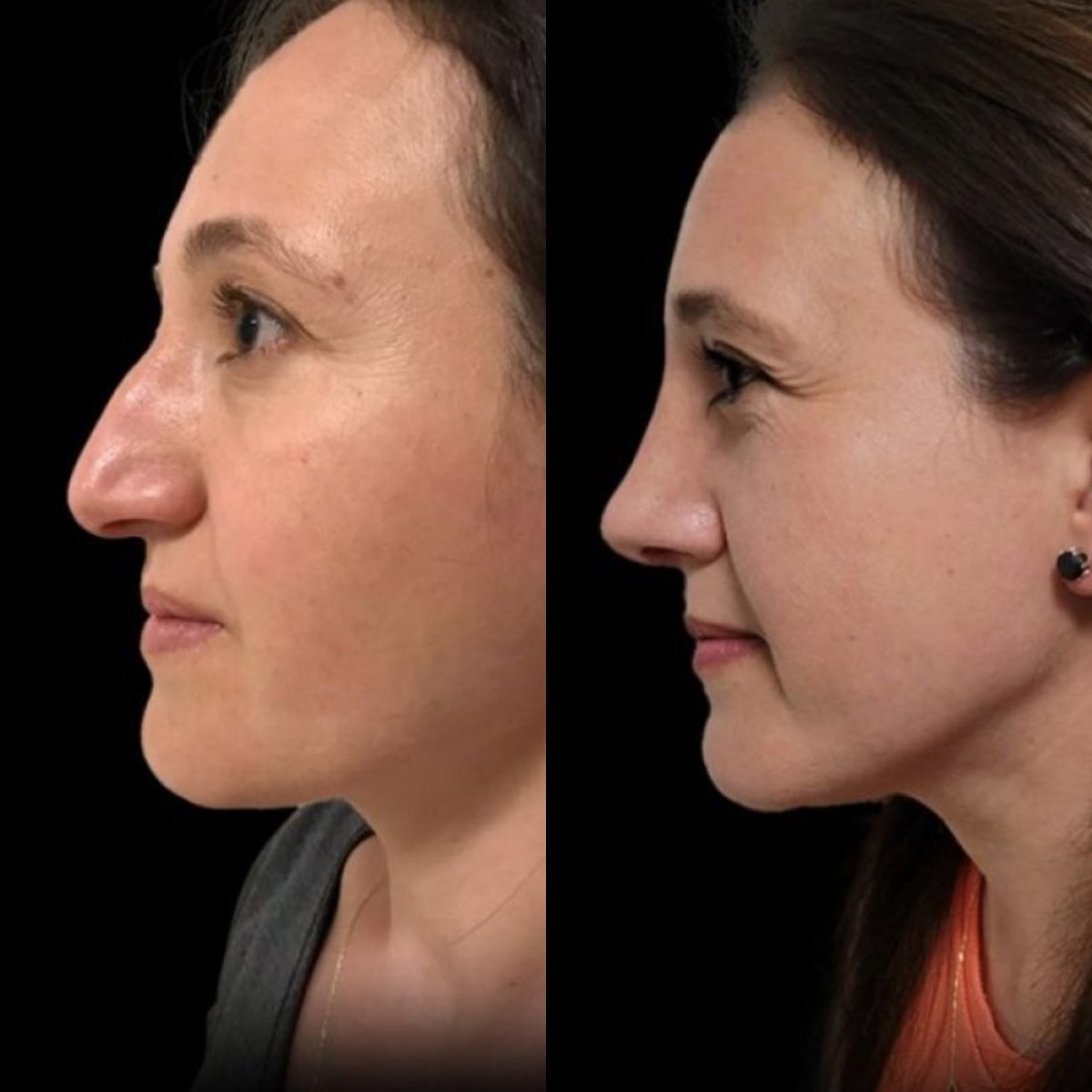Resultados antes y después de rinoplastia ultrasónica en Medical Park Antalya Hospital Complex