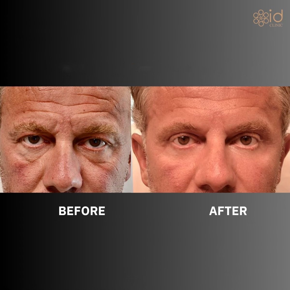 Before and after lower eyelid blepharoplasty results at ID Clinic Bangkok, reduced eye bags
