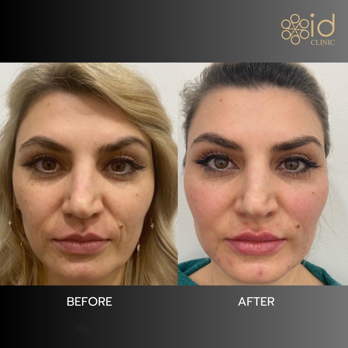Résultats avant et après lifting par fils à ID Clinic Bangkok, amélioration du contour du visage