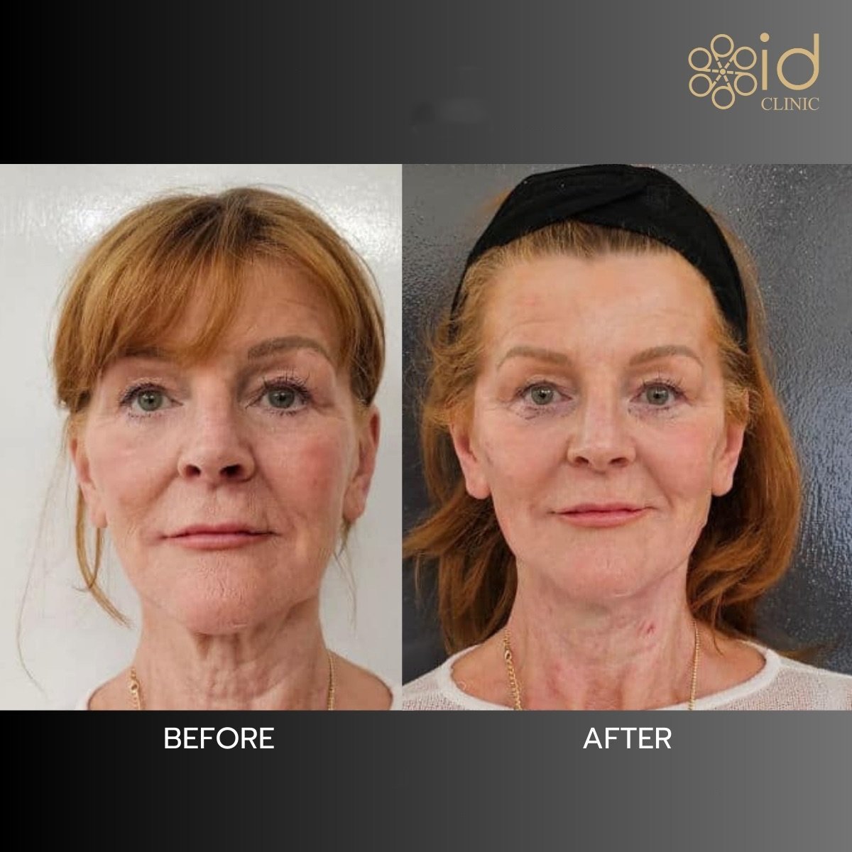 Resultado antes y después de lifting con hilos en ID Clinic Bangkok, rejuvenecimiento facial visible