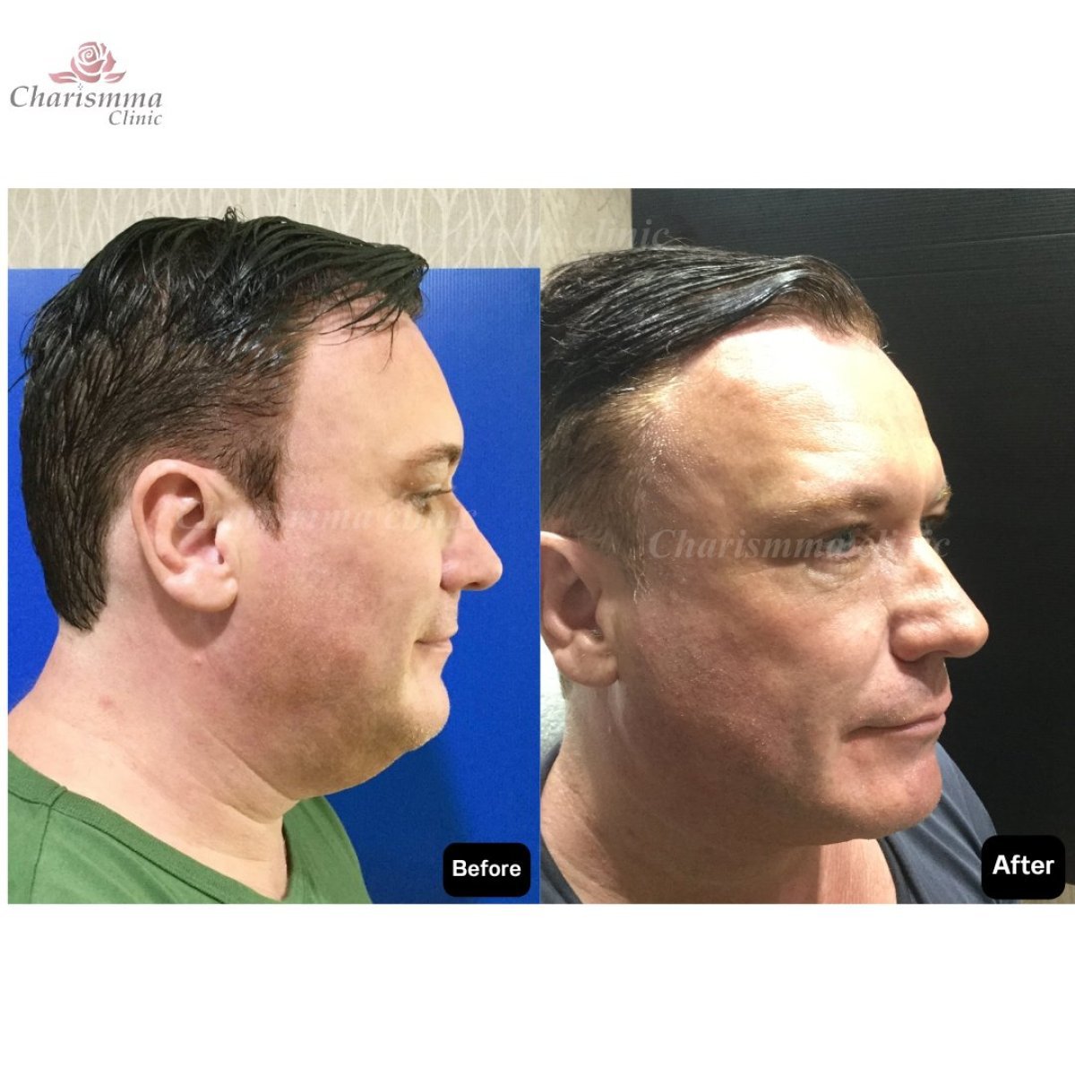 Before and after face contouring results at Charismma Clinic, improved jawline definition