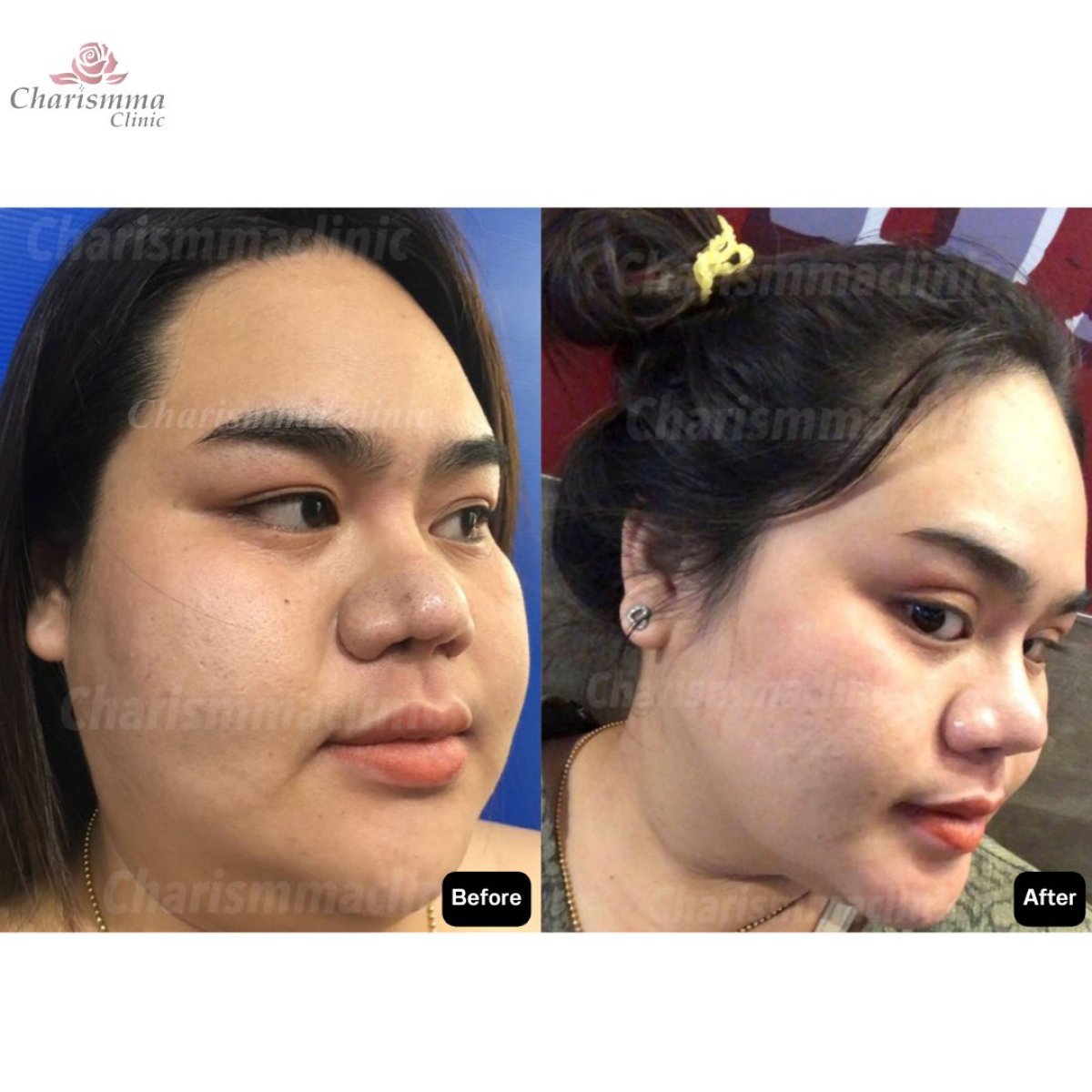 Resultados de contorno facial antes y después en Charismma Clinic, efecto de adelgazamiento visible