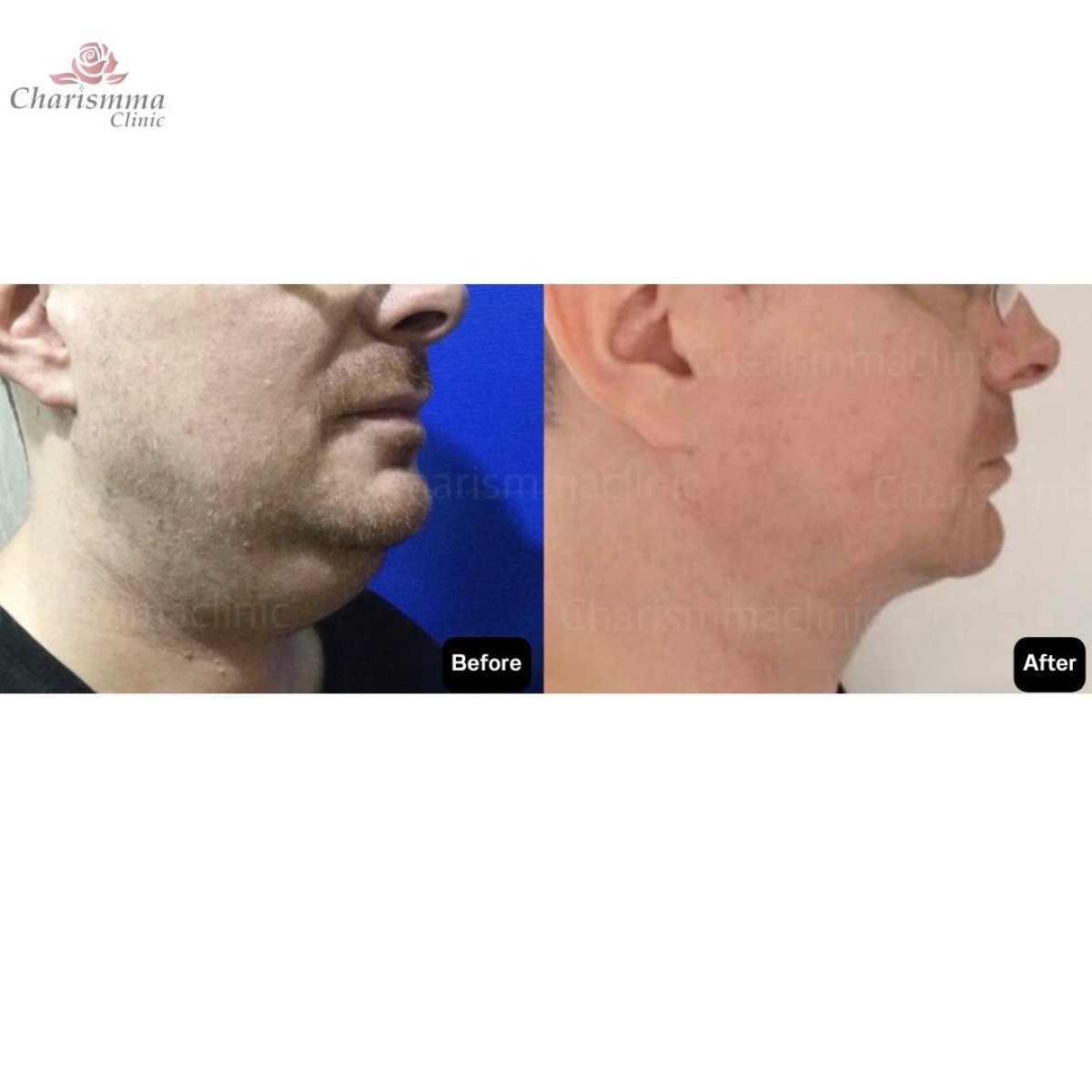 Antes y después de contorno facial en Charismma Clinic, mejora de mentón y mandíbula