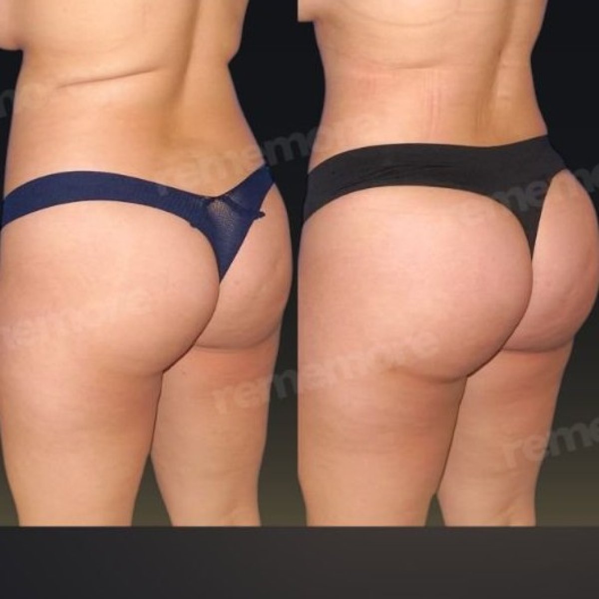 Avant et après implants fessiers à Memorial Göztepe Hospital – contour des fesses amélioré