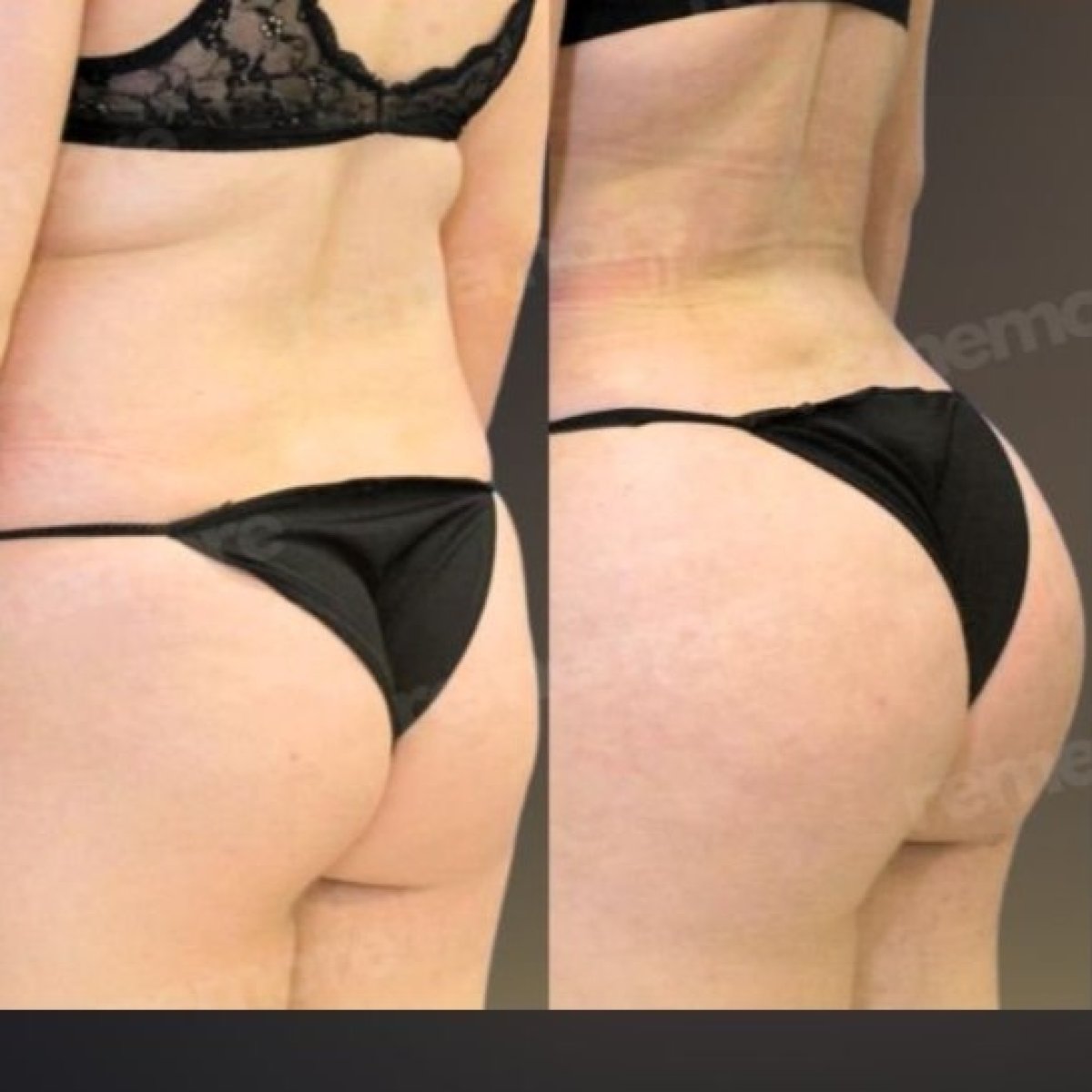 Avant-après implants fessiers à Memorial Göztepe Hospital, résultat contour amélioré