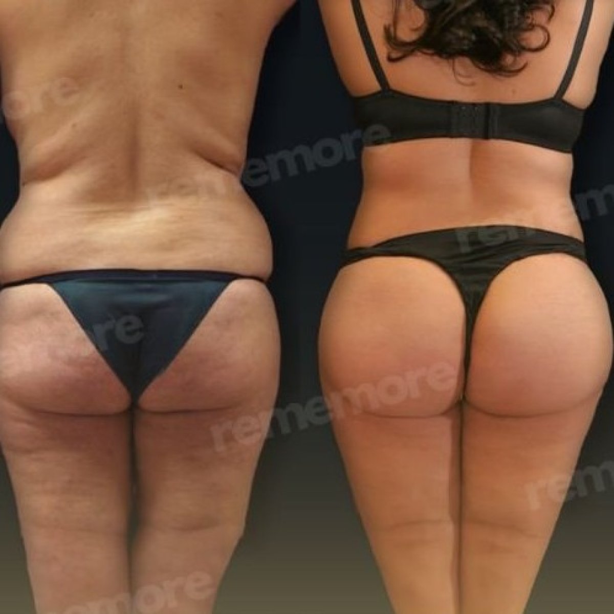 Before and after butt implants at Memorial Göztepe Hospital, enhanced contour and lift result