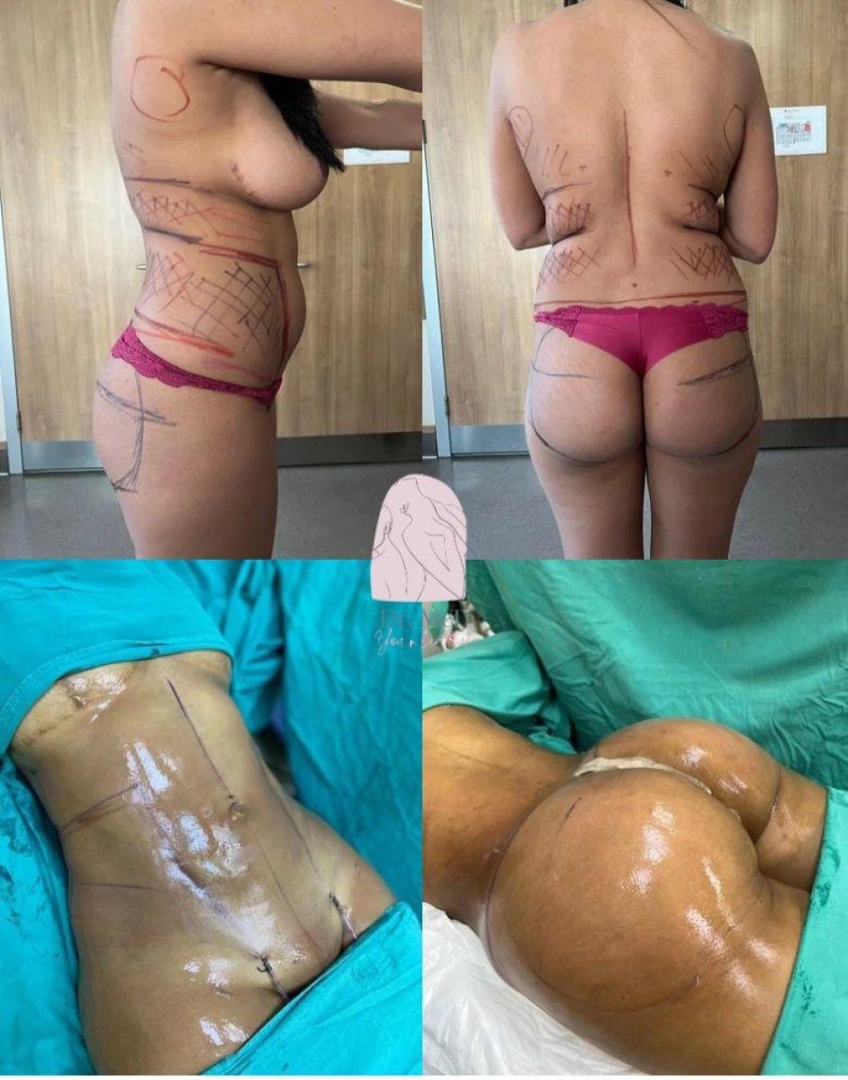 نتائج شفط الدهون ونحت الجسم قبل وبعد في عيادة Dr. MED، إزالة الدهون بوضوح