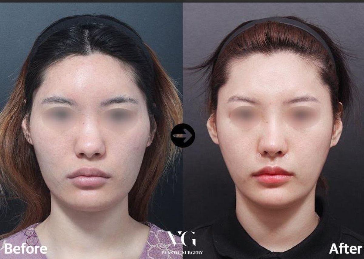 نتيجة قبل وبعد جراحة الذقن المنزلقة في VG Plastic Surgery، تحسين شكل الذقن