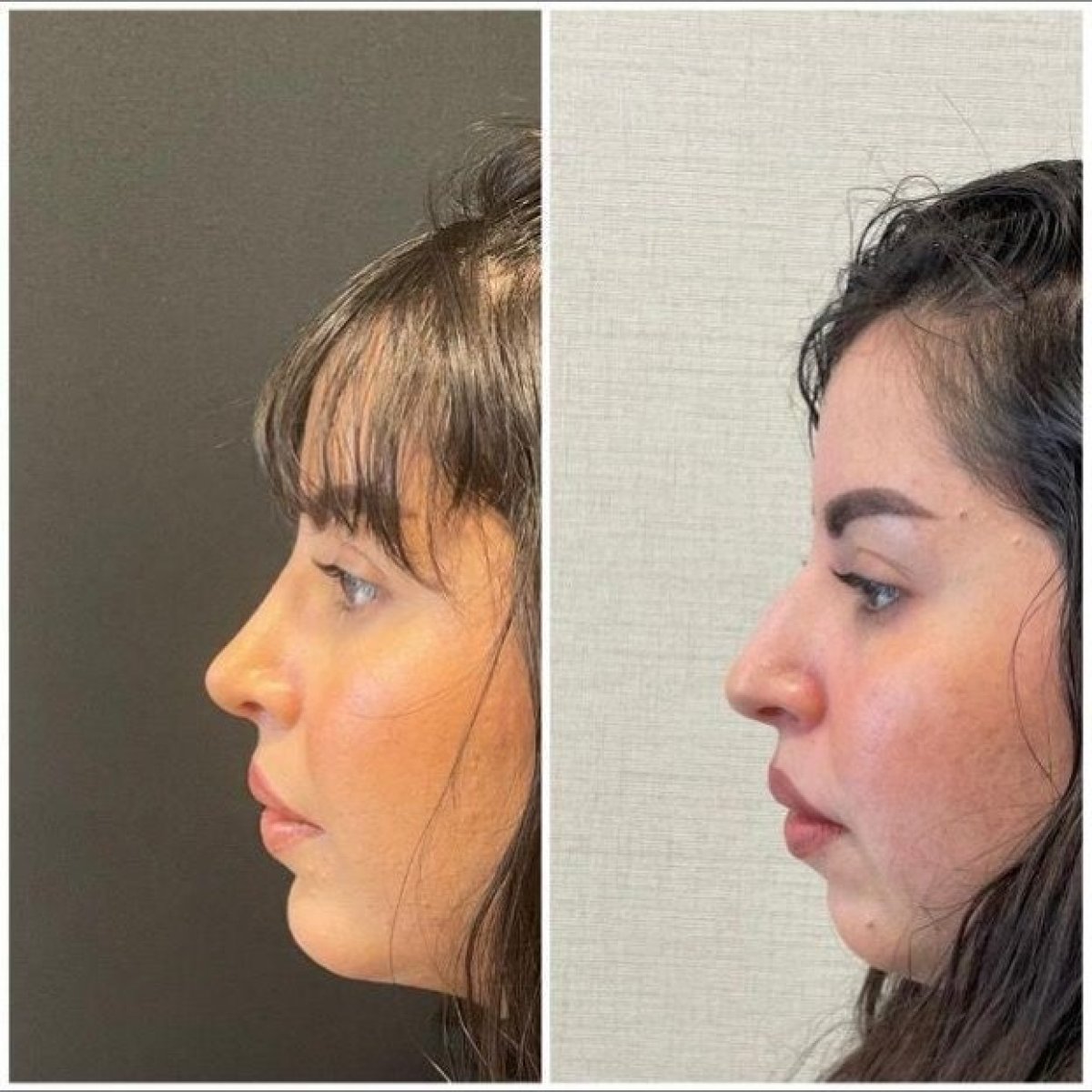 Before and after chin implant results at Op. Dr. Sinan Eroglu Clinic, enhanced chin profile