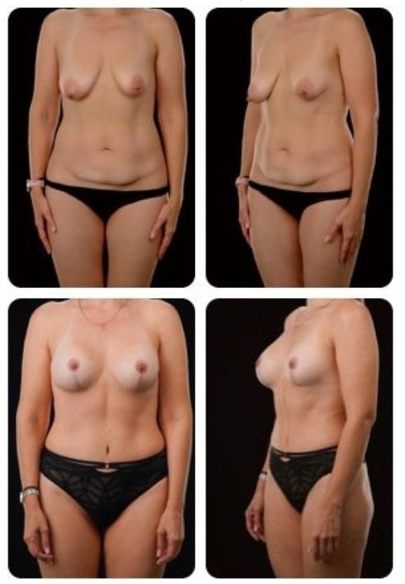 Результаты до и после абдоминопластики и увеличения груди в Yurchenko Plastic Surgery Kyiv