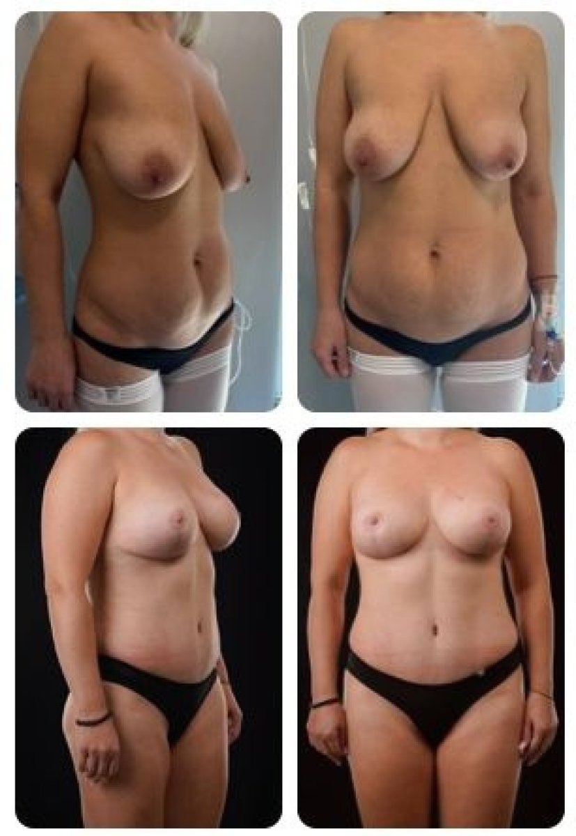 Результаты до и после абдоминопластики в Yurchenko Plastic Surgery Team Kyiv, плоский живот