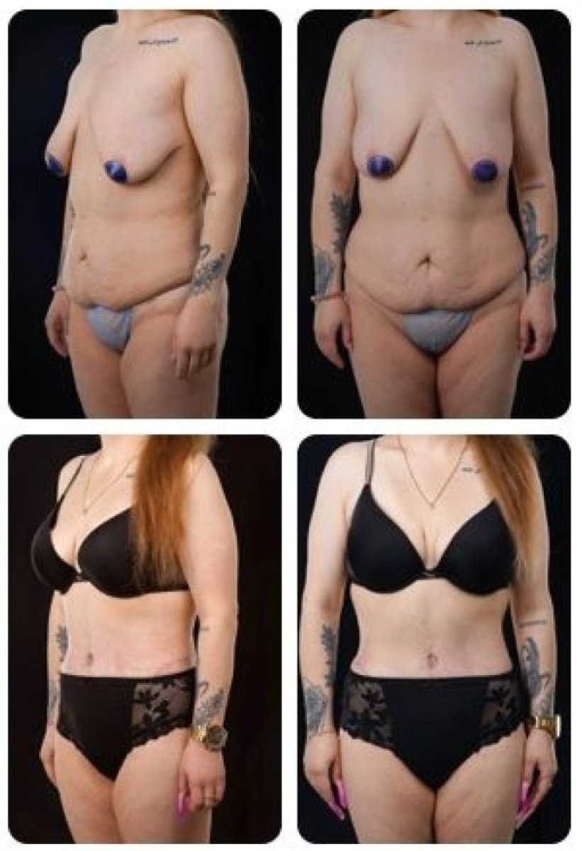 نتائج شد البطن قبل وبعد في Yurchenko Plastic Surgery Team Kyiv، تحسين شكل الجسم