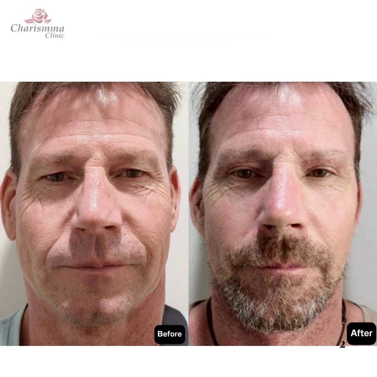 نتائج قبل وبعد شد الوجه العميق في Charismma Clinic، تجديد واضح للوجه