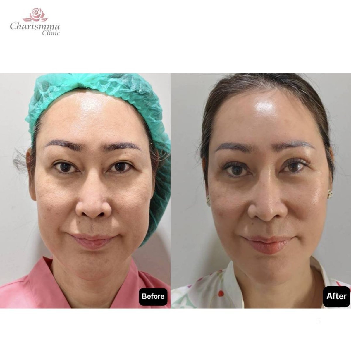 Результаты до и после Deep Plane Facelift в Charismma Clinic, видимое омоложение лица