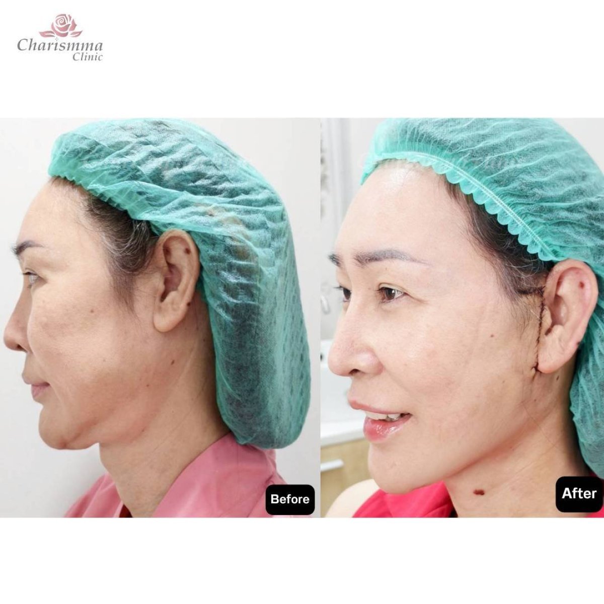 Resultados de lifting facial antes y después en Charismma Clinic – rejuvenecimiento visible