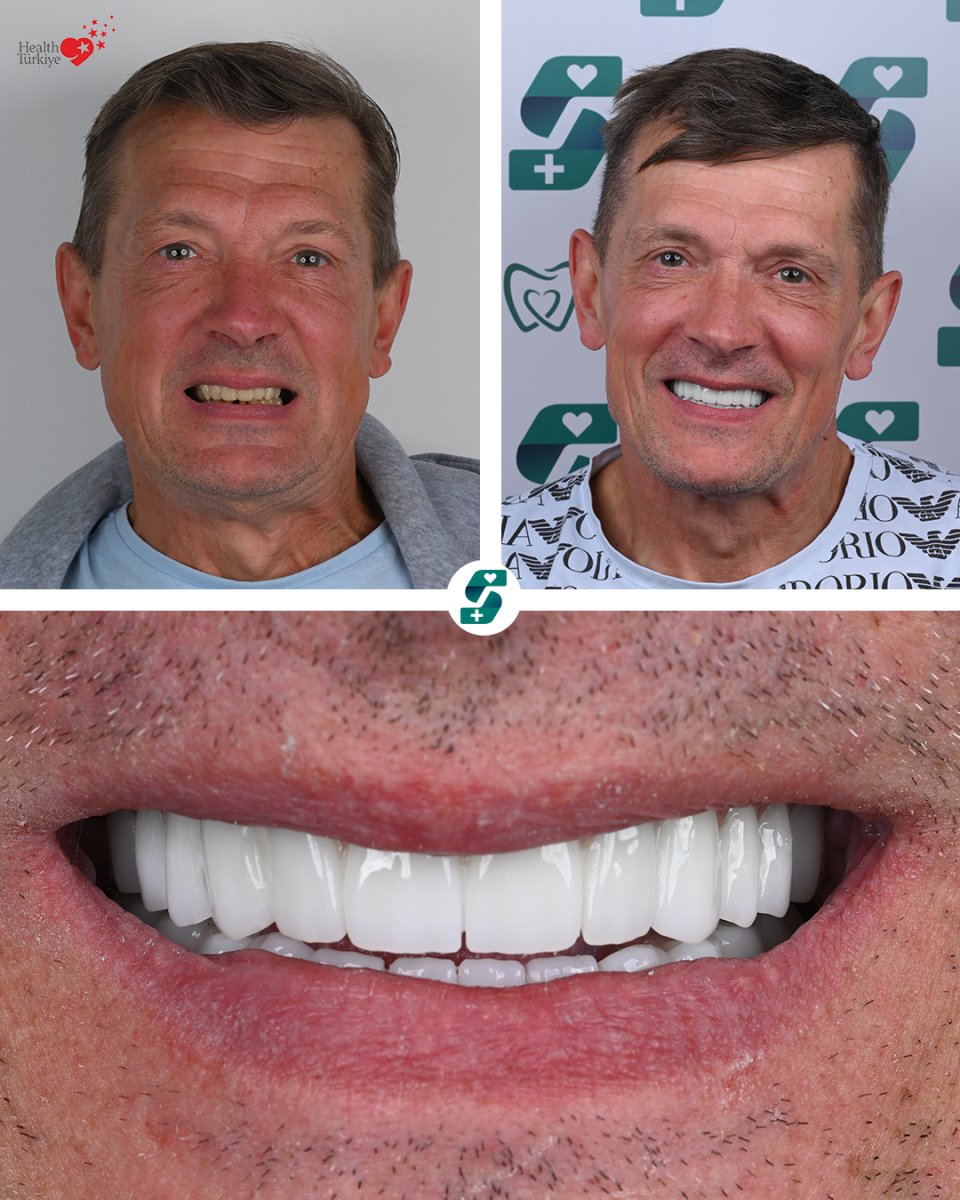 Resultados de antes y después de smile makeover en Soraca Med – estética dental mejorada