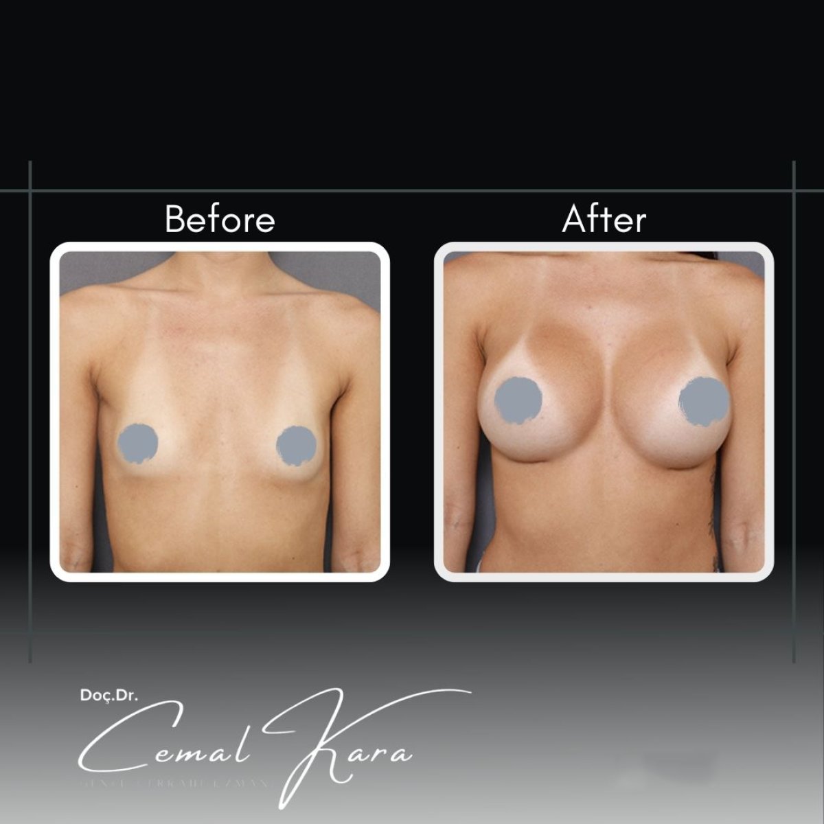 Before and after breast augmentation results at Assoc.Prof.Dr.Cemal Kara / Medical Park İzmir