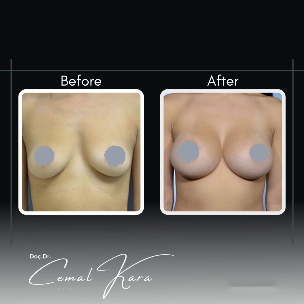 Before and after breast augmentation results at Assoc.Prof.Dr.Cemal Kara / Medical Park İzmir